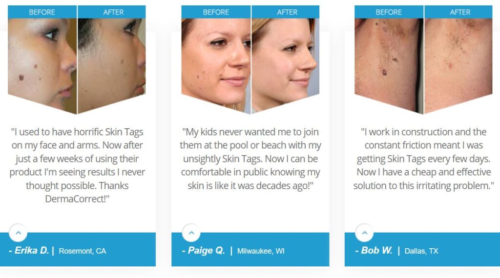 At home tricks to remove skin tags